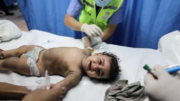L'immagine mostra un bambino sdraiato su un lettino in un contesto medico. Il bambino, con un'espressione di dolore o disagio, è senza camicia e indossa solo un pannolino. Due adulti, probabilmente medici o infermieri, stanno assistendo il bambino, uno dei quali tiene un bracciale e sembra essere concentrato sulla cura. Lo sfondo è costituito da tende blu, tipico per gli ambienti ospedalieri. L'atmosfera appare seria e si percepisce un clima di urgenza e attenzione.
